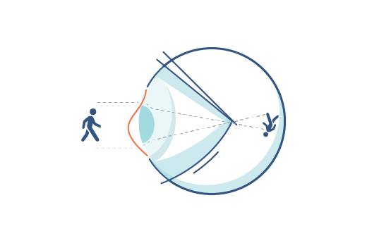 Illustration of an eye with an astigmatism